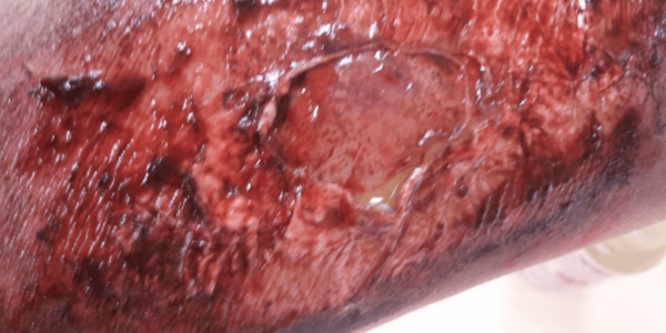 SFX-Halloween-Makeup-Artist-Burn-Wound