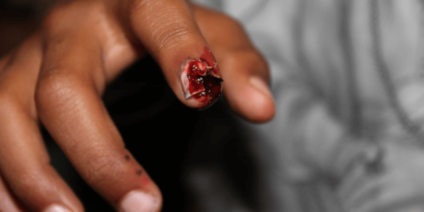SFX-Halloween-Makeup-Artist-Finger-Injury
